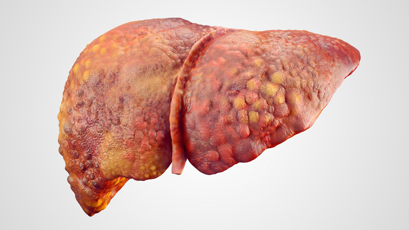 Accumulation of Fatty Tissue in the Liver