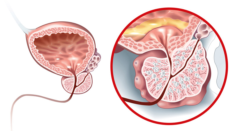 Anatomy of Benign Prostatic Hyperplasia