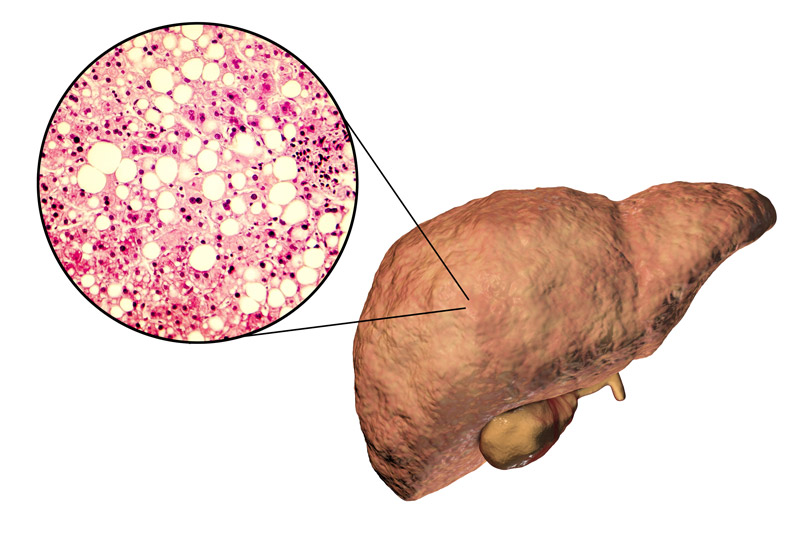 Fatty Liver with Lipid Accumulation