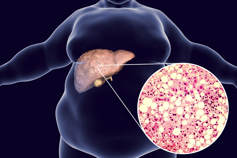 Fatty Tissue in the Liver