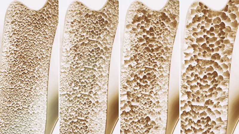 Progression from Osteopenia to Osteoporosis